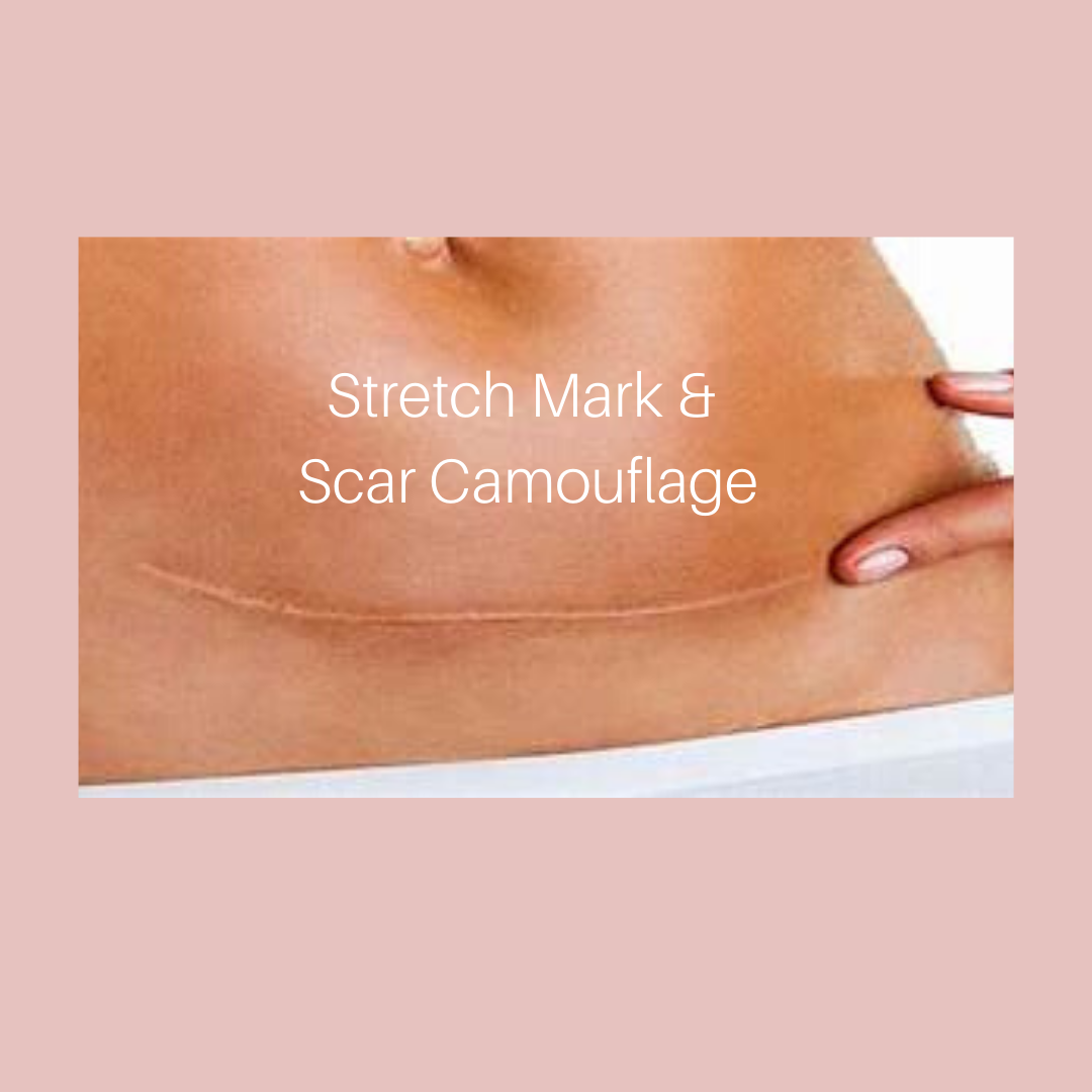Scar and Stretch Mark Tattoo Camouflage | BeautyInkByLeanne